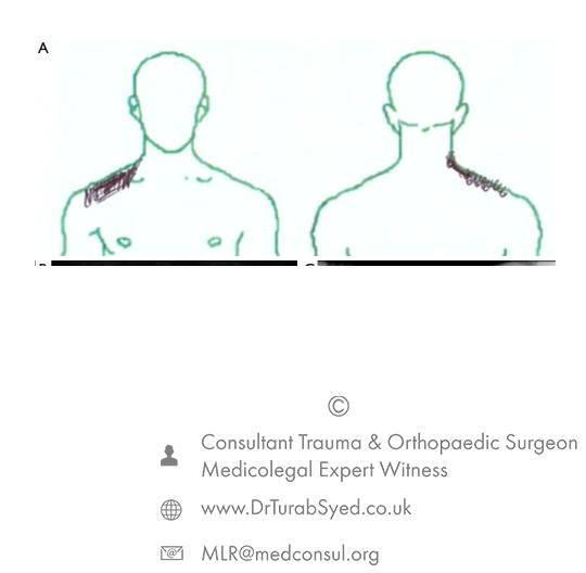 radiculopathy