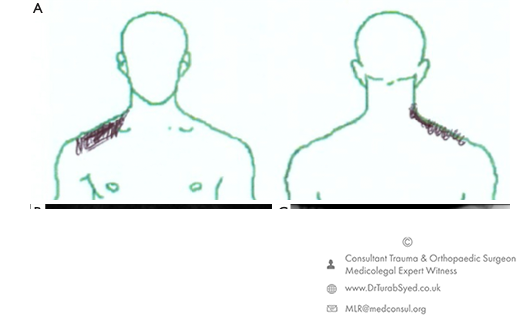 radiculopathy