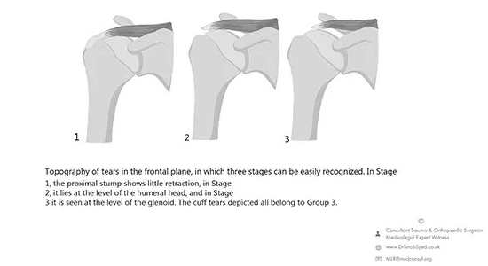 rotator cuff tear