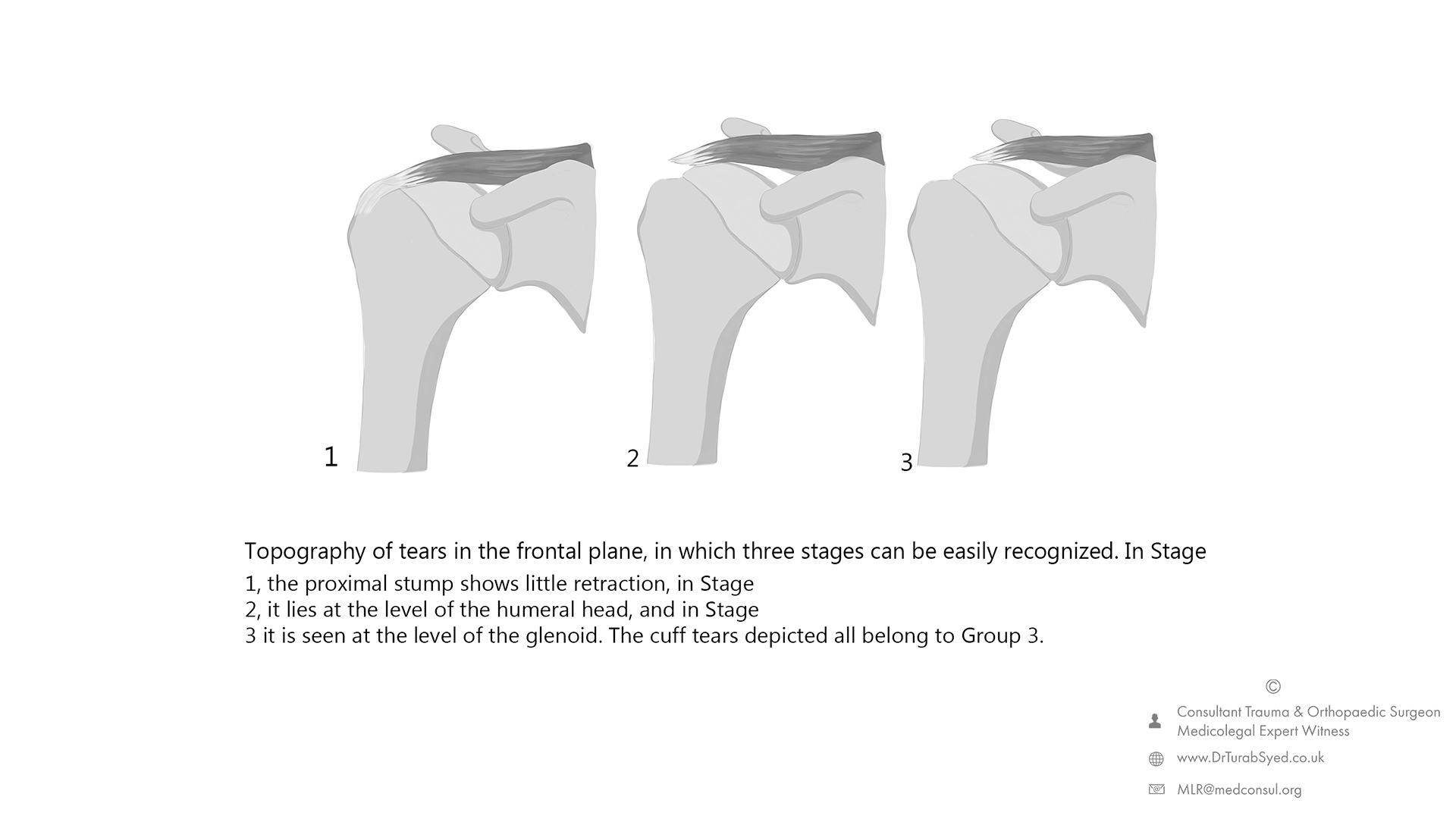 rotator cuff tear