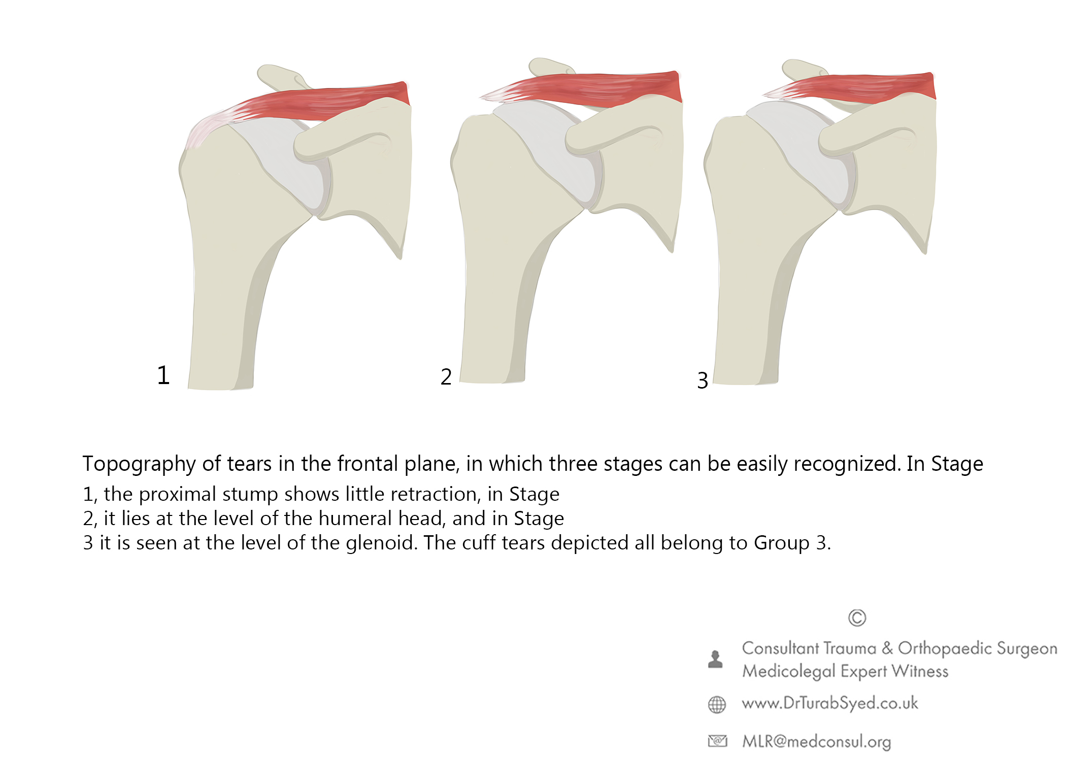 rotator cuff tear 2