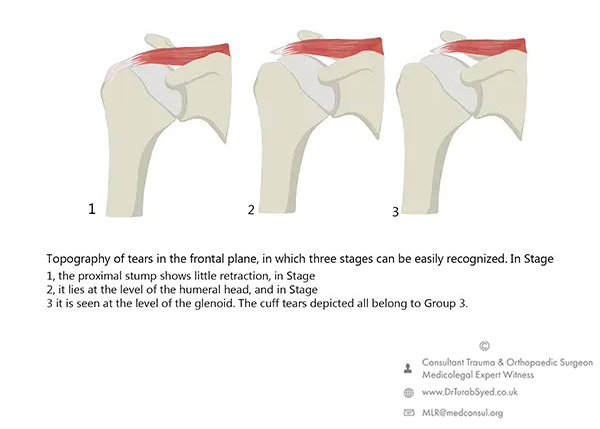 rotator cuff tear 2