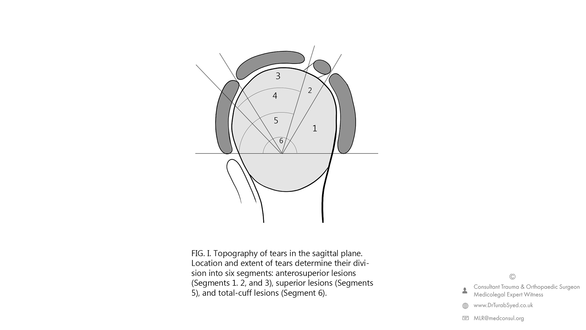 rotator cuff tear segments