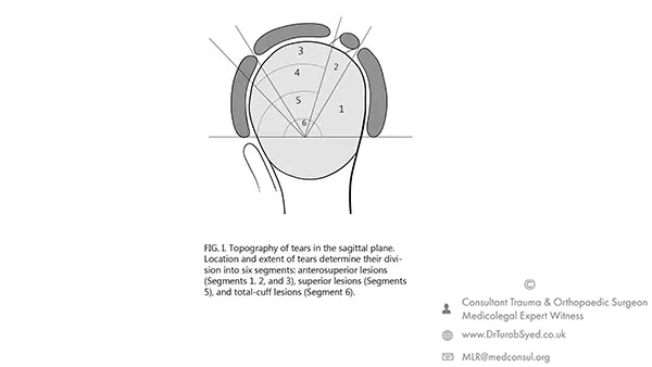 rotator cuff tear segments