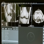 Knee cartilage repair: microfracture or nanofracture procedure?